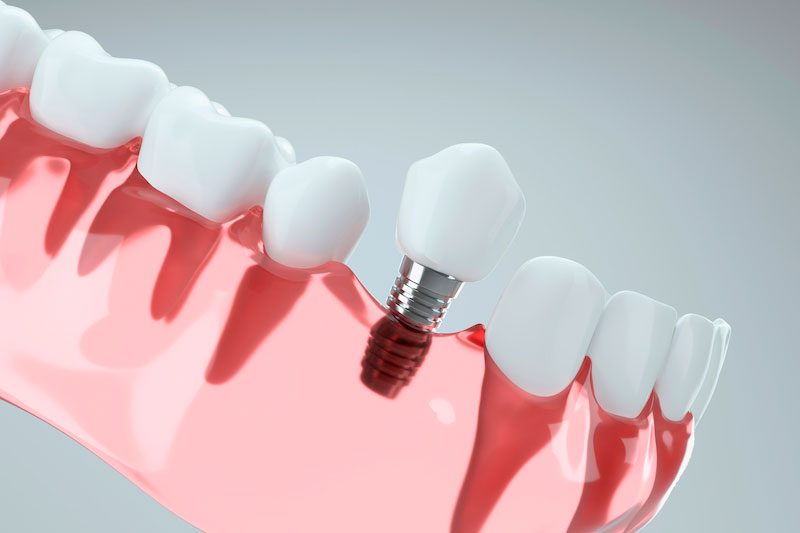 Implantes Dentales
